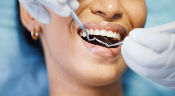 Best Dental Fillings (Composite and Amalgam)  in USA